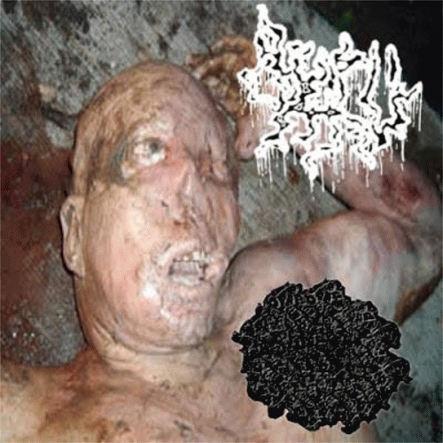 Anal Fissure : Anal Fissure - Laparoscopic Resection Of An Undifferentiated Pleomorphic Splenic Sarcoma